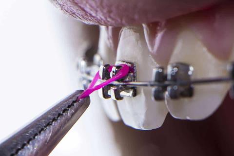 تفسير رؤية سقوط تقويم الاسنان في المنام للعزباء خير أم شر
