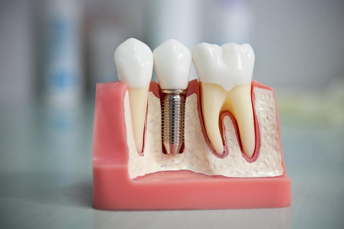 زراعة الأسنان بدون جراحة 2023